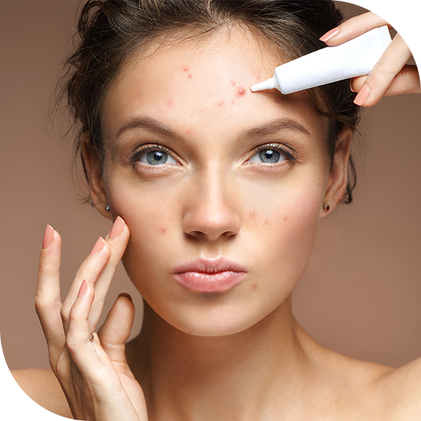 premier_acne