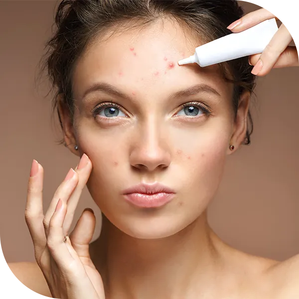 premier_acne