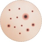 개방 면포(블랙헤드)